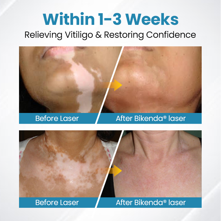 Bikenda® Evena Vitiligo Therapy Device PRO