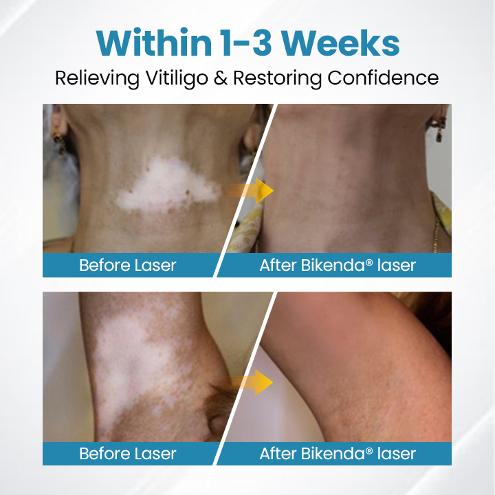 Bikenda® Evena Vitiligo Therapy Device PRO