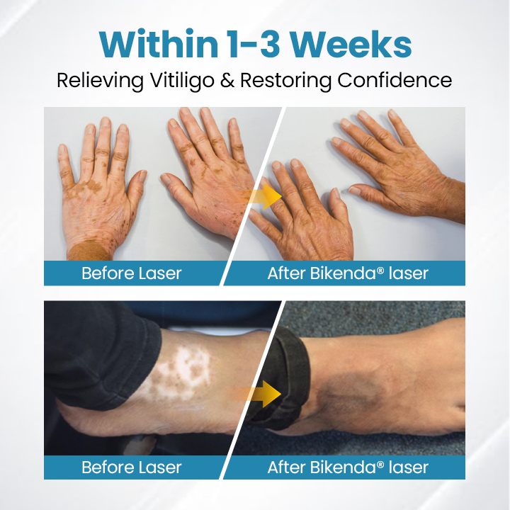 Bikenda® Evena Vitiligo Therapy Device PRO
