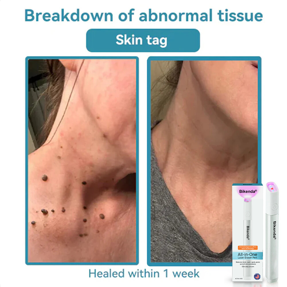 ✨Bikenda® All-in-One CO₂ Laser Eraser Pen | Removes Moles, Warts, Skin Flaws & Pigmentation
