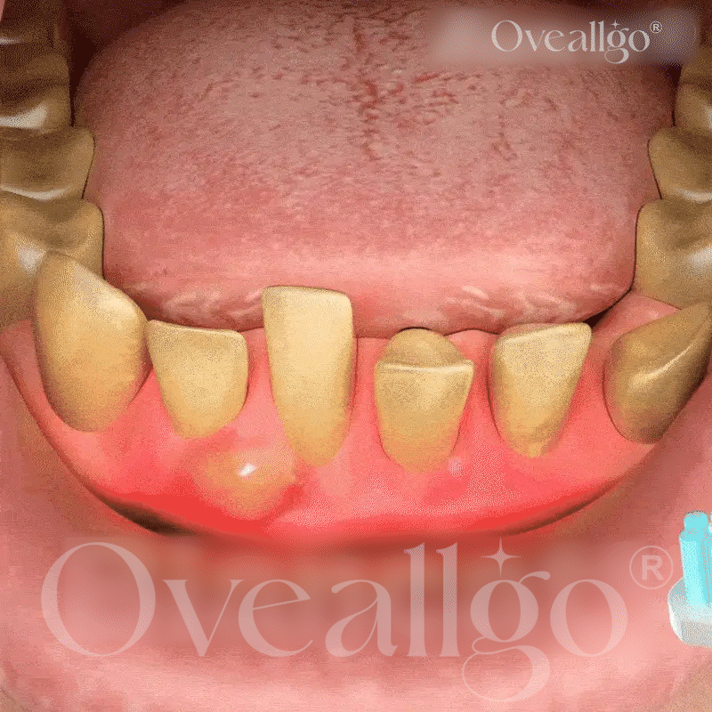 Oveallgo® BeeRenew Advanced Gum Healing Toothpaste