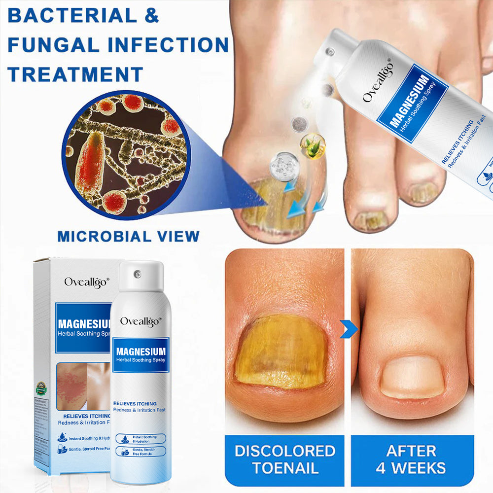 Oveallgo® Magnesium Herbal Psoriasis Spray
