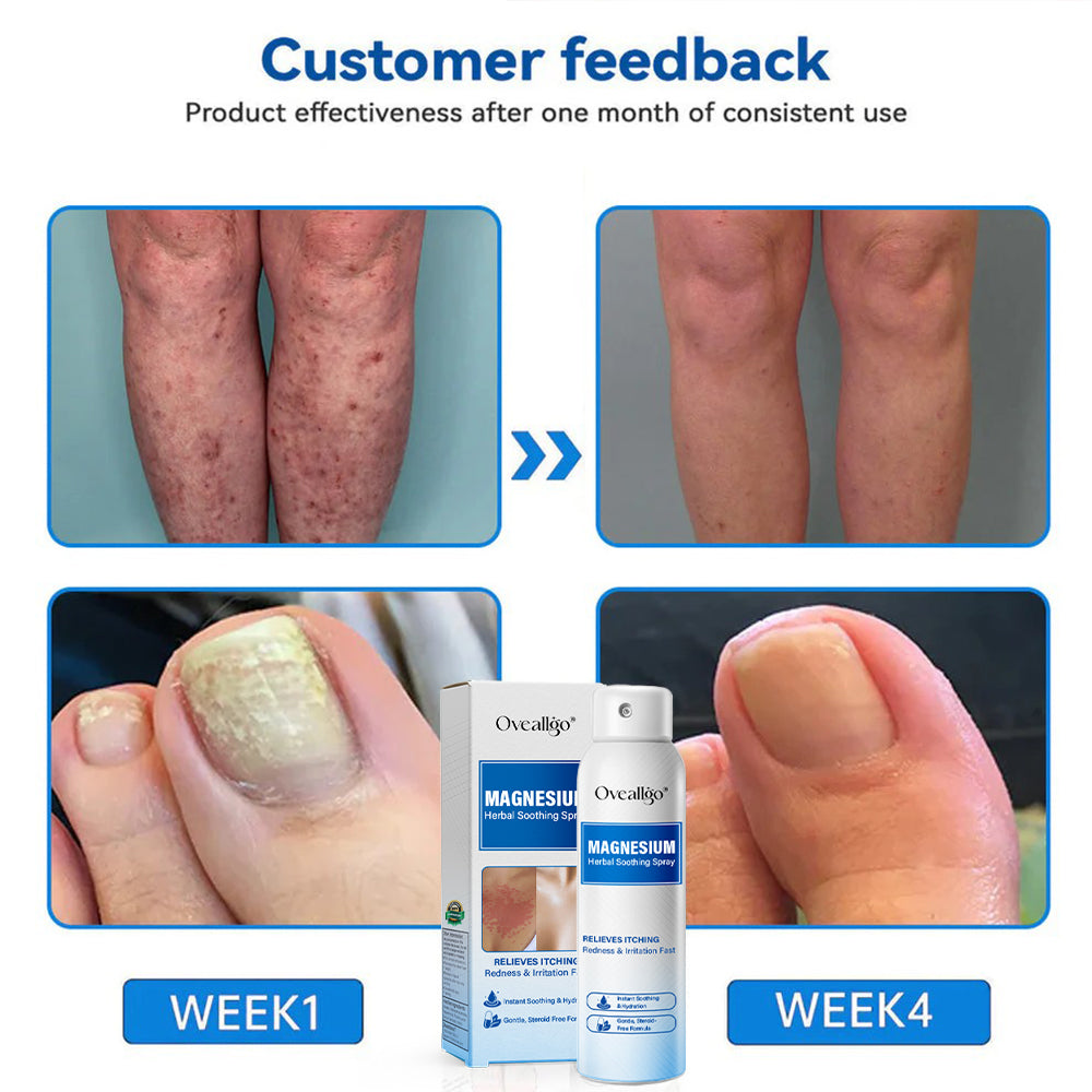 Oveallgo® Magnesium Herbal Psoriasis Spray