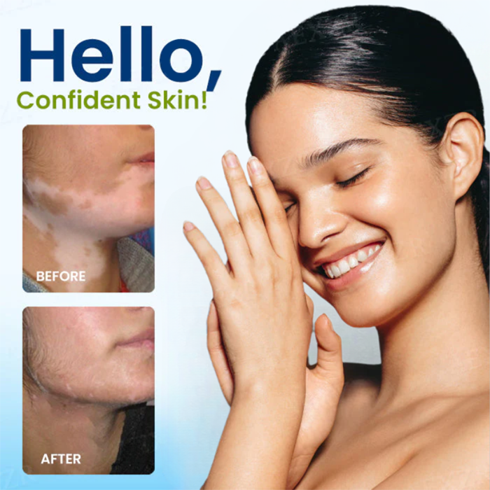 Fivfivgo® Vitiligo Treatment Spray