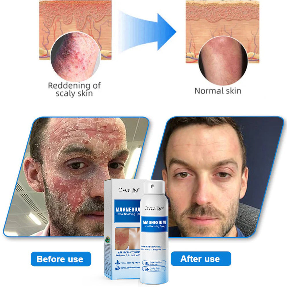 Oveallgo® Magnesium Herbal Psoriasis Spray