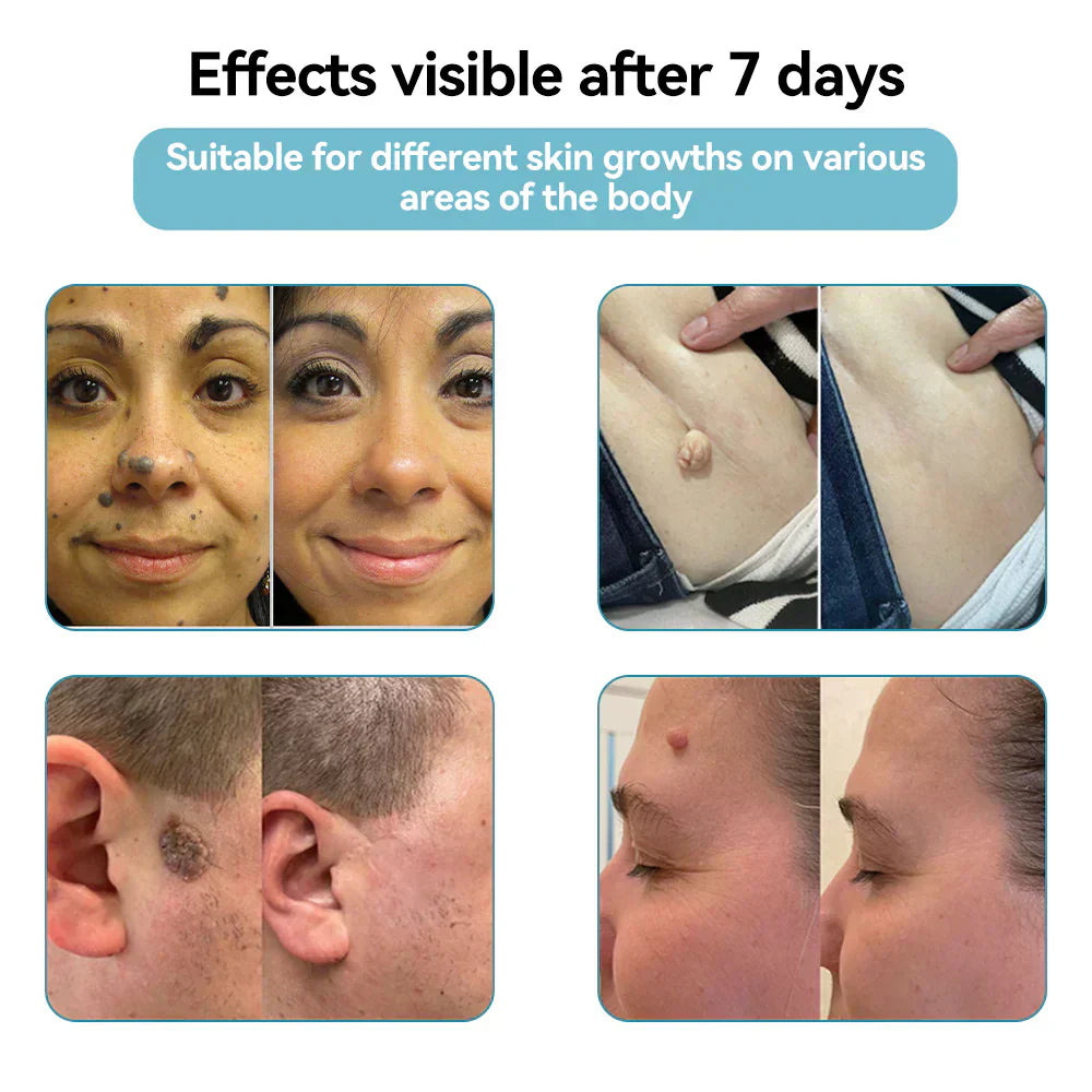 ✨Bikenda® All-in-One CO₂ Laser Eraser Pen | Removes Moles, Warts, Skin Flaws & Pigmentation