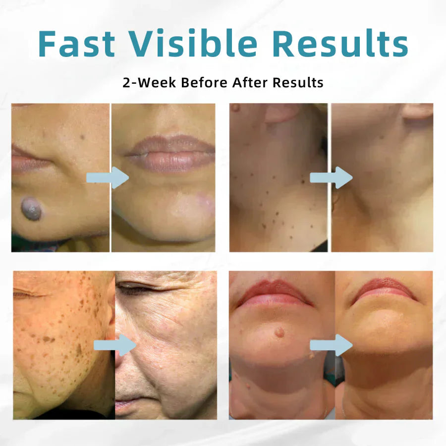 ✨Bikenda® All-in-One CO₂ Laser Eraser Pen | Removes Moles, Warts, Skin Flaws & Pigmentation