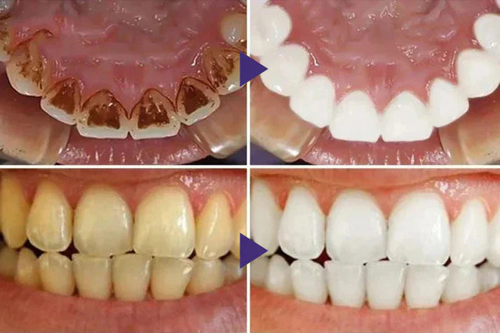 Oveallgo® Gum Care Gel – Restore & Strengthen Your Gums