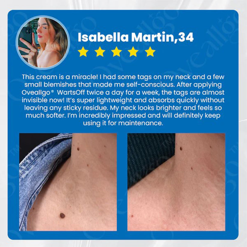 ✅ Official Store: Oveallgo® WartsOff Pro Instant Blemish Removal Cream👩⚕️USA Dermatology Association (AADA)Approved (Skin Tags, Warts, Dark Spots Removal)
