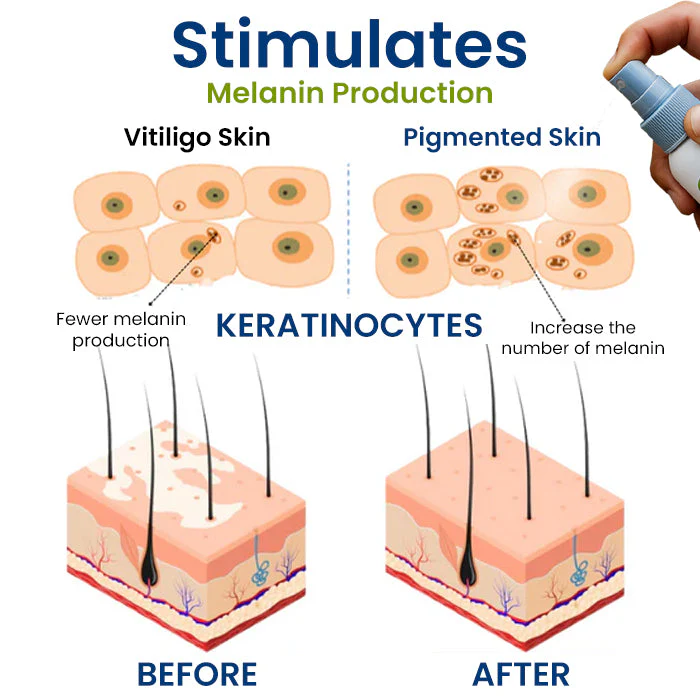 Fivfivgo® Vitiligo Treatment Spray