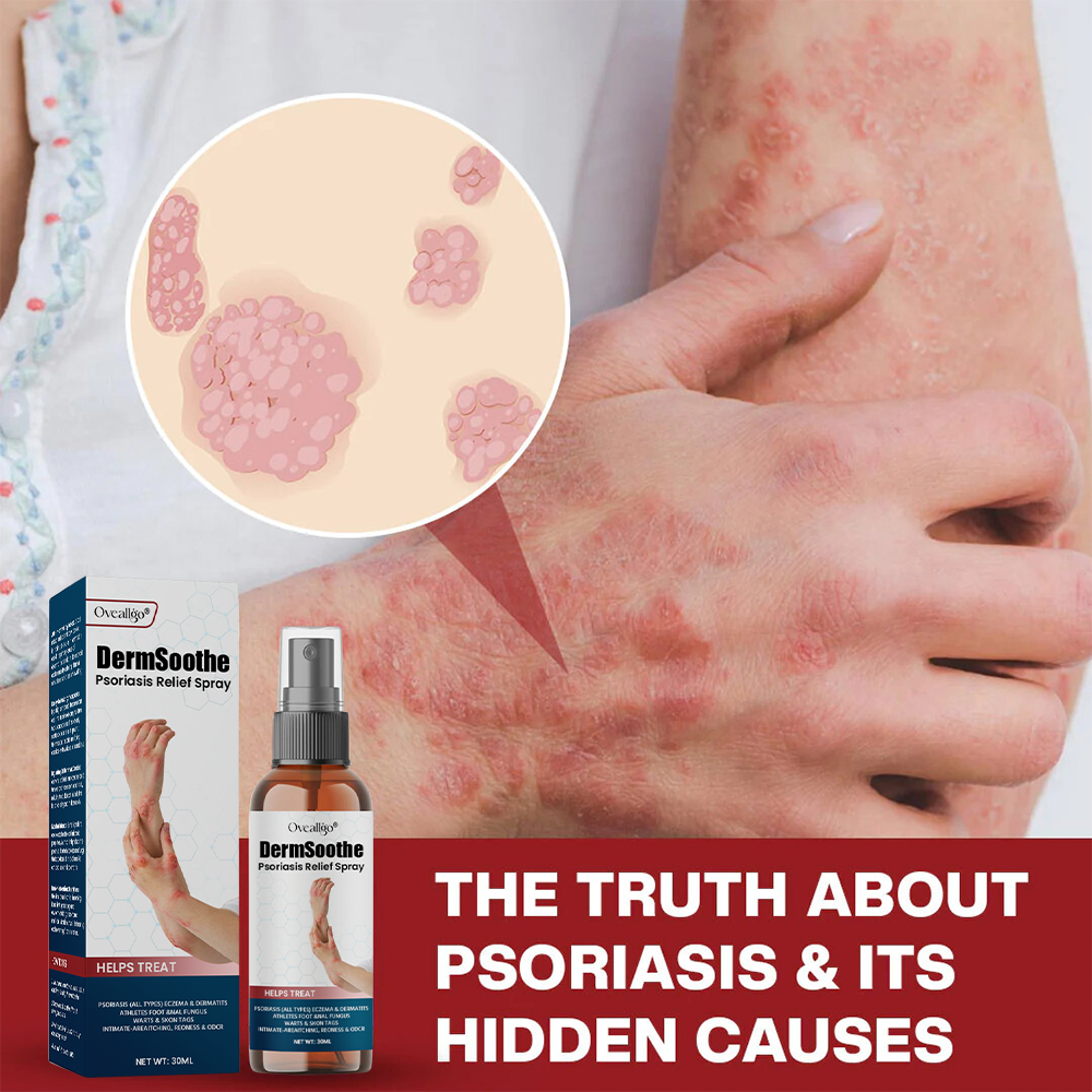 Oveallgo® DermSoothe Psoriasis Relief Spray
