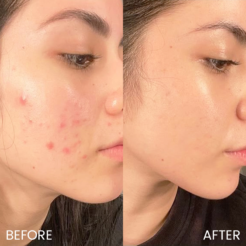 Oveallgo® SpiculeCalm 1000 Pore-Refine Serum