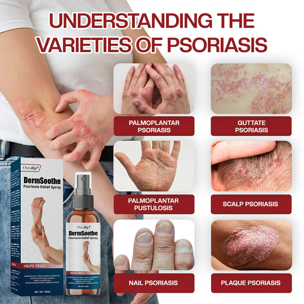 Oveallgo® DermSoothe Psoriasis Relief Spray