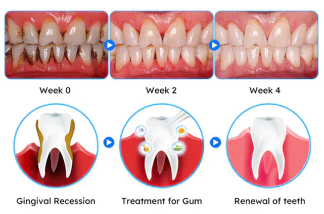 Oveallgo® Gum Care Gel – Restore & Strengthen Your Gums
