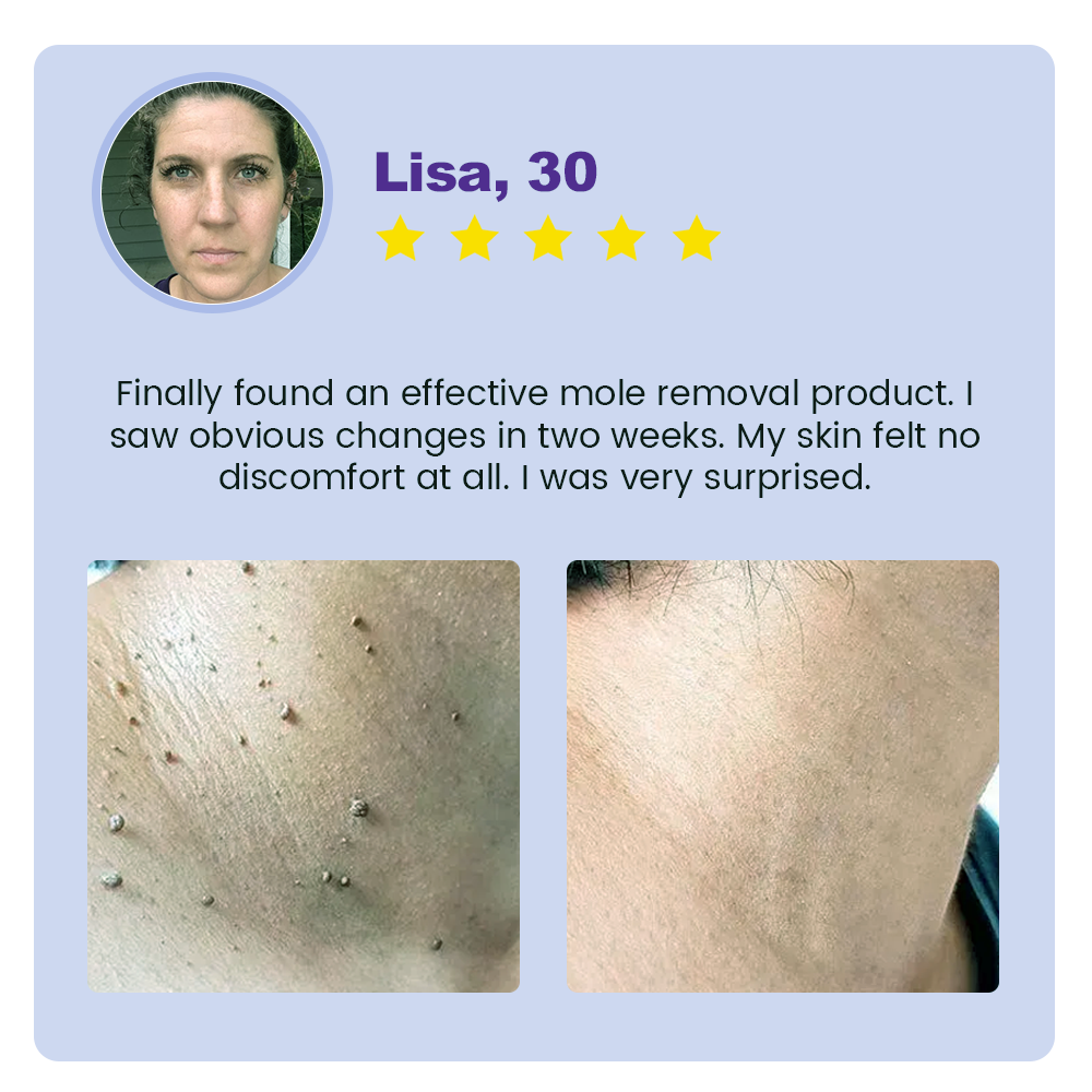 Oveallgo® Clarivine Dissolver Pro Mole & Dark Spot Removal Bio-Gel