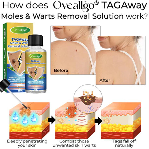 Oveallgo® TAGAway Moles & Warts Removal Solution