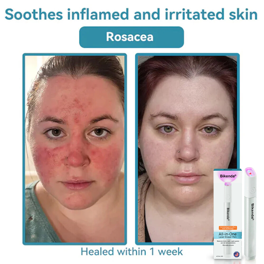 ✨Bikenda® All-in-One CO₂ Laser Eraser Pen | Removes Moles, Warts, Skin Flaws & Pigmentation