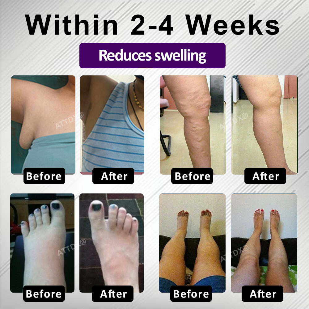 Oveallgo® NightDrain Leg Therapy Edema Cream