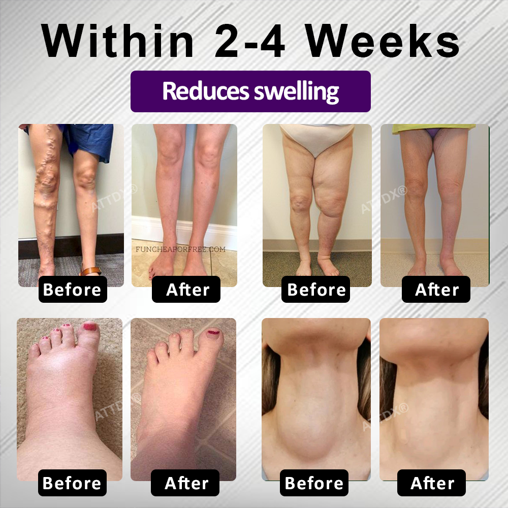 Oveallgo® NightDrain Leg Therapy Edema Cream