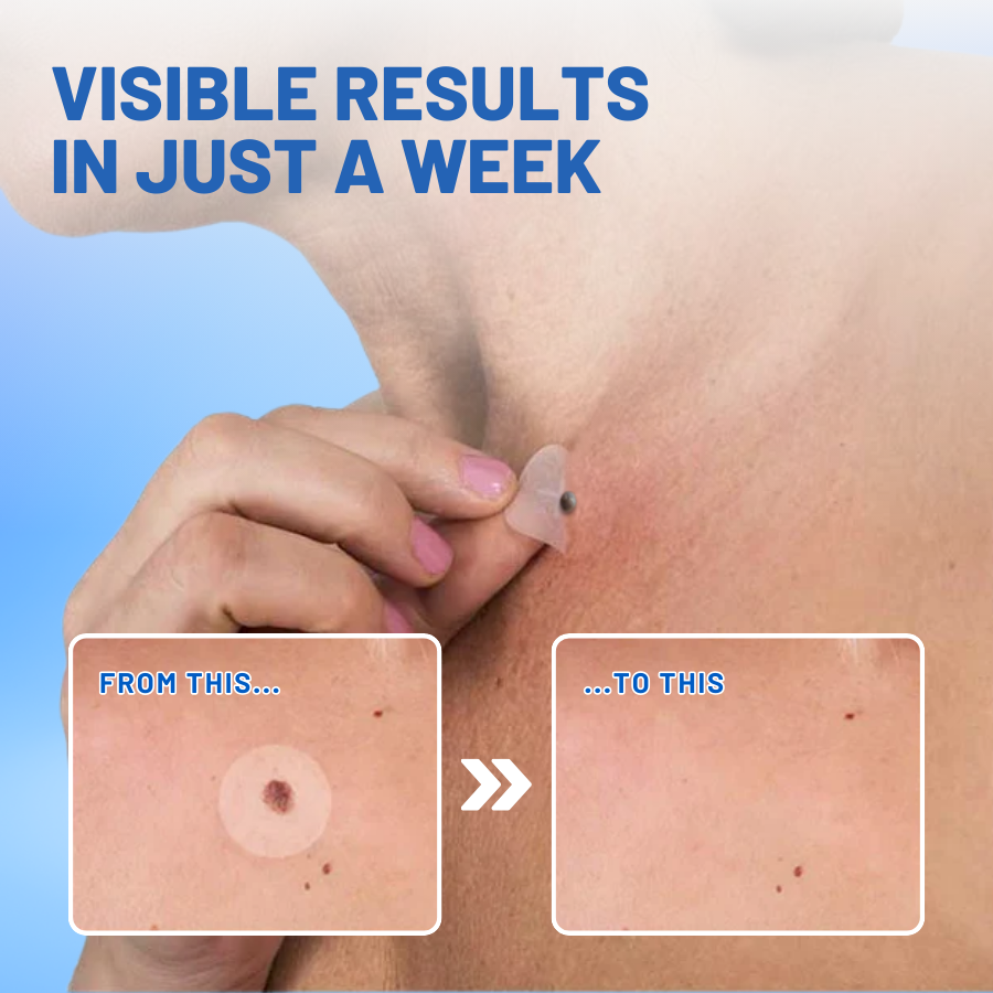 Fivfivgo® Moles & Warts Removing Skin Tag Patch