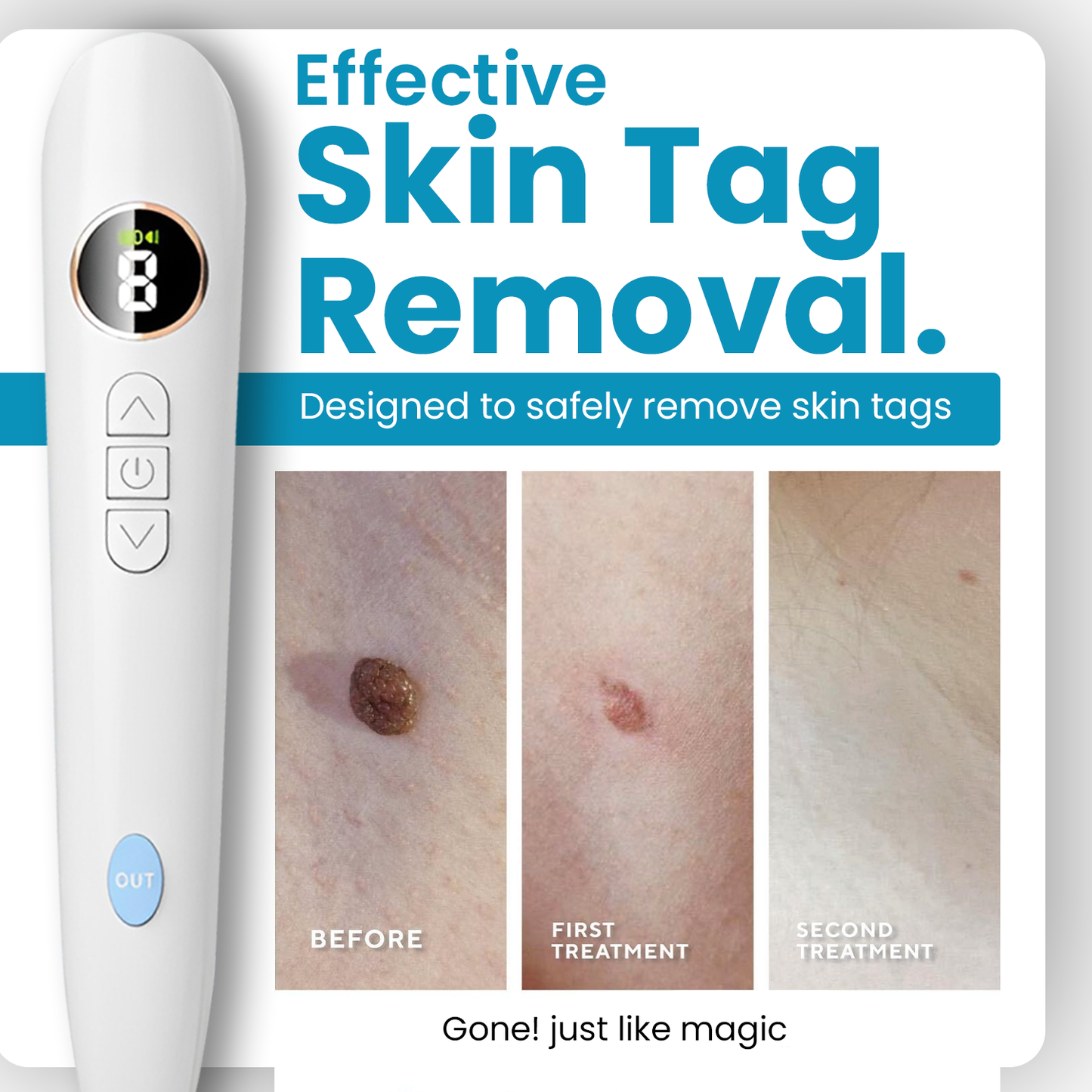 Bikenda® Home Use CO2 Laser Shot Erase Pro