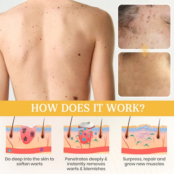 Oveallgo® NATURESTORE Instant Mole & Spot Cream