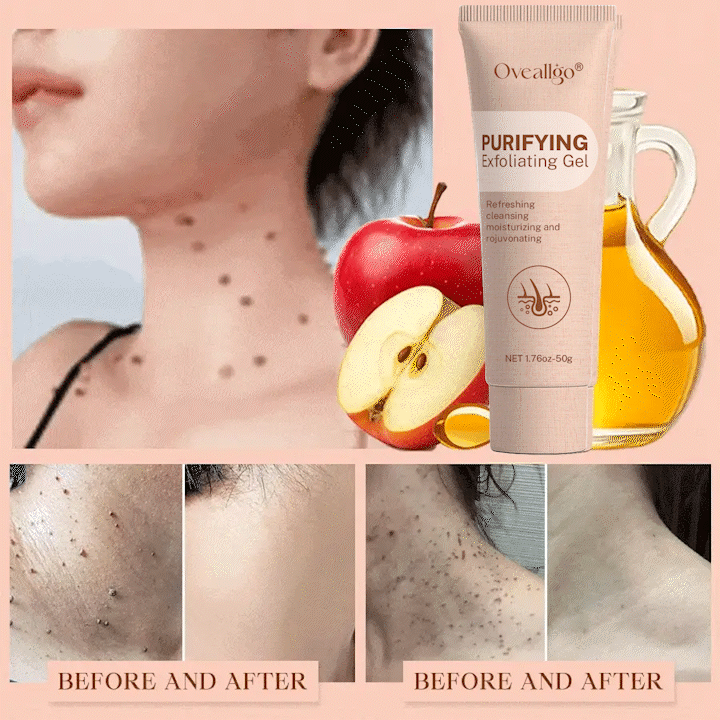 Oveallgo® Purifying Exfoliating Gel for Acanthosis Nigricans, Exfoliation, Dark Spots, Skin Tags, and Eczema_Ultra01