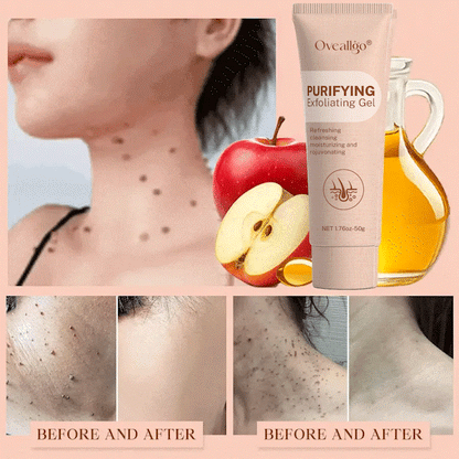 Oveallgo® Purifying Exfoliating Gel for Acanthosis Nigricans, Exfoliation, Dark Spots, Skin Tags, and Eczema_Ultra01