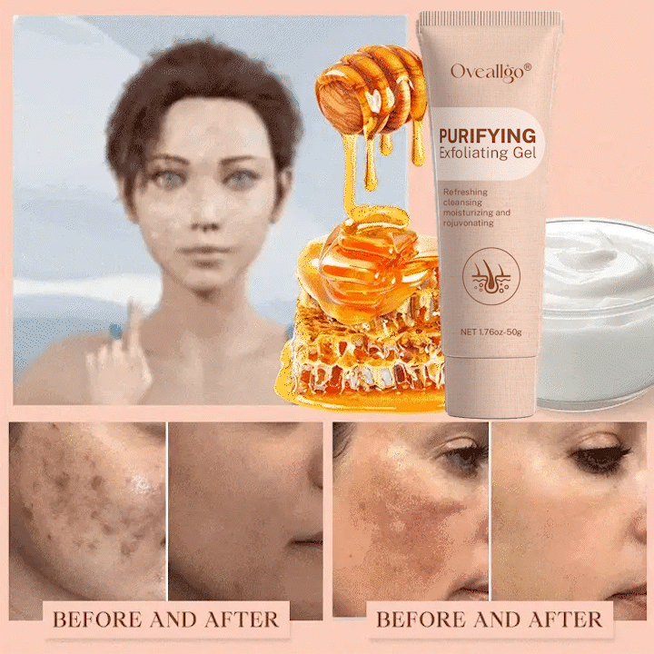 Oveallgo® Purifying Exfoliating Gel for Acanthosis Nigricans, Exfoliation, Dark Spots, Skin Tags, and Eczema_Ultra01