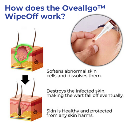 ✅Official Store: Oveallgo™ WipeOff Tags & Moles Remover 👨‍⚕️The Australasian College of Dermatologists (ACD) Approved