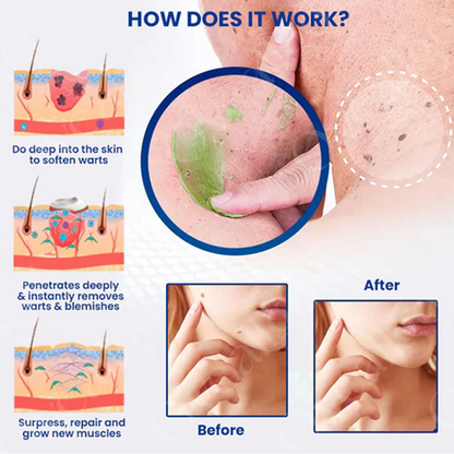 ✅ Official Store: Oveallgo™ NatureErase Instant Mole & Spot Cream
