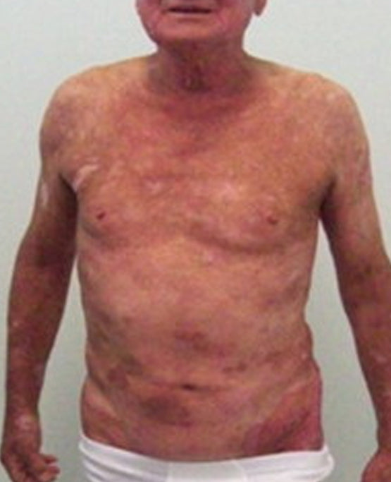 Oveallgo® Shingles Calm Snake Peptide Ampoules 26 Oveallgo® Shingles Calm Snake Peptide Ampoules