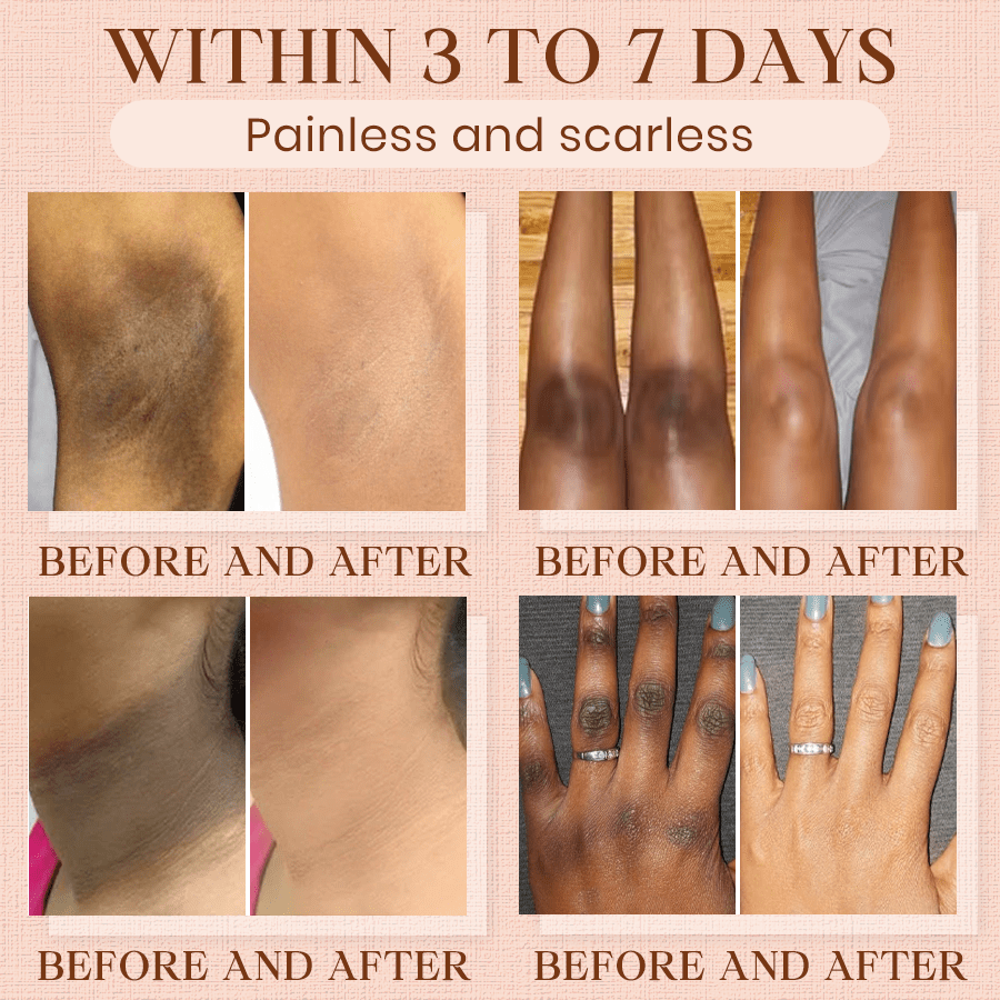 Oveallgo® Purifying Exfoliating Gel for Acanthosis Nigricans, Exfoliation, Dark Spots, Skin Tags, and Eczema_Ultra01