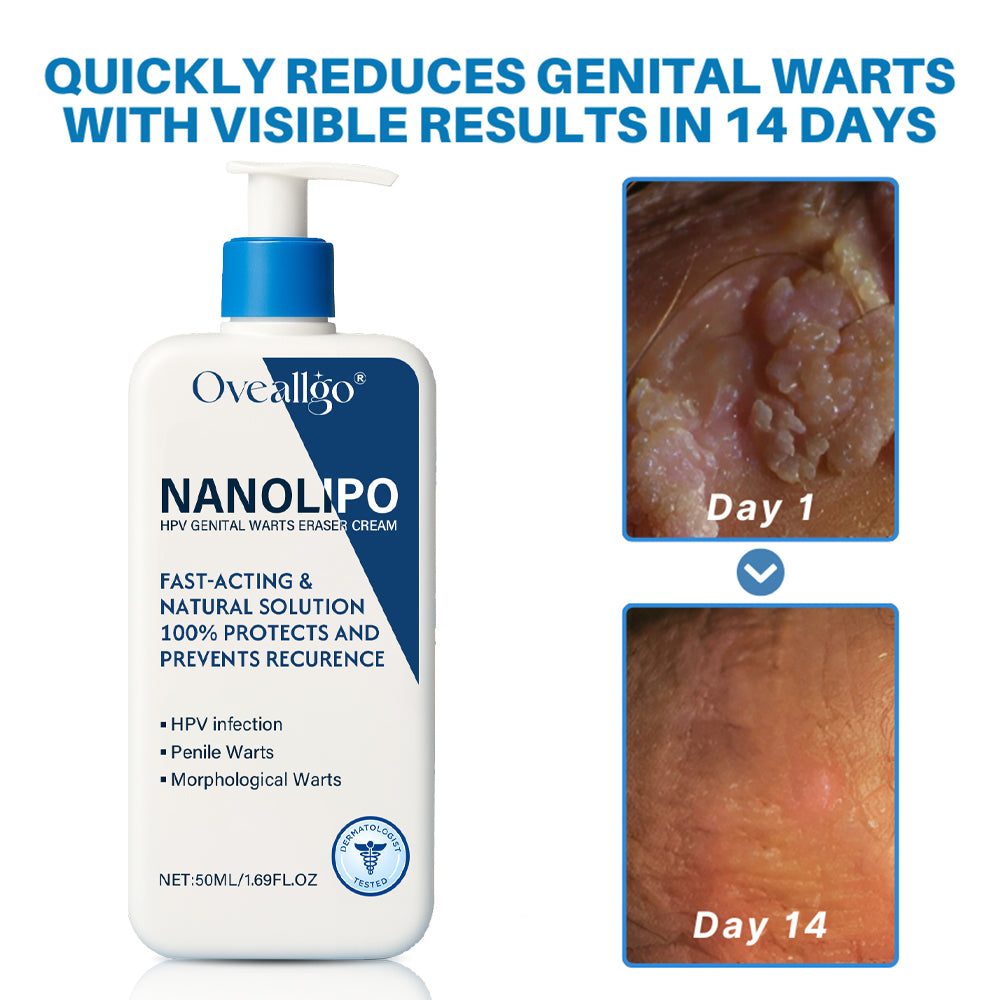Oveallgo® NanoLipo HPV Genital Warts Eraser Cream Ultra 16 Oveallgo® NanoLipo HPV Genital Warts Eraser Cream Ultra