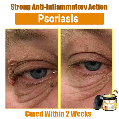 ✅Official Store: Oveallgo™ Bee Venom Skin Treatment Cream (𝐴𝐴𝐷 𝑅𝑒𝑐𝑜𝑚𝑚𝑒𝑛𝑑𝑒𝑑) ✨Anti-aging, Hydrating, Skin Repair, Even Tone, Acne and Dark Spot Treatment, Wartand Mole Removal, PsoriasisRelief