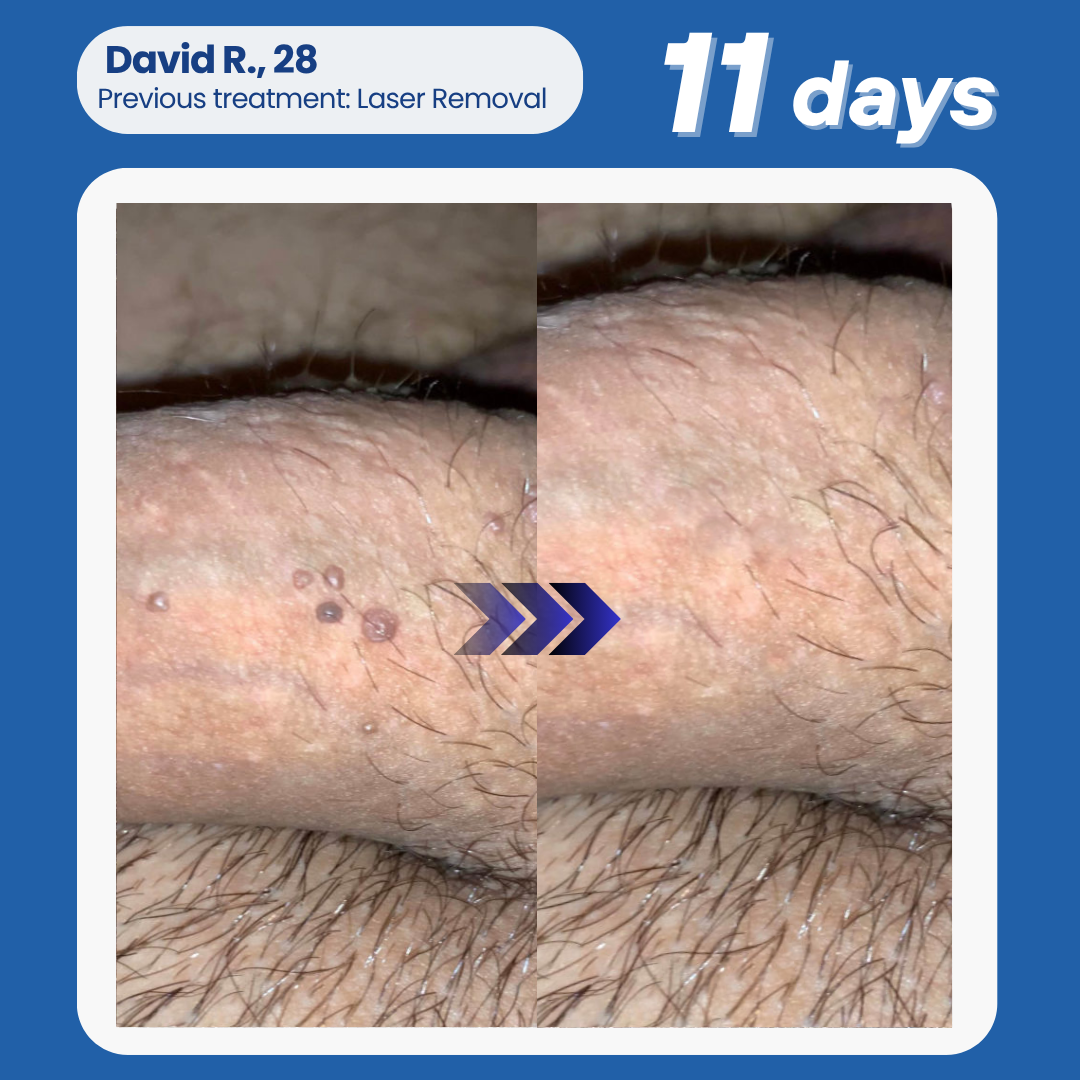 Oveallgo® NANOLIPO GENITAL WARTS CLINICAL AMPOULES 18 Oveallgo® NANOLIPO GENITAL WARTS CLINICAL AMPOULES