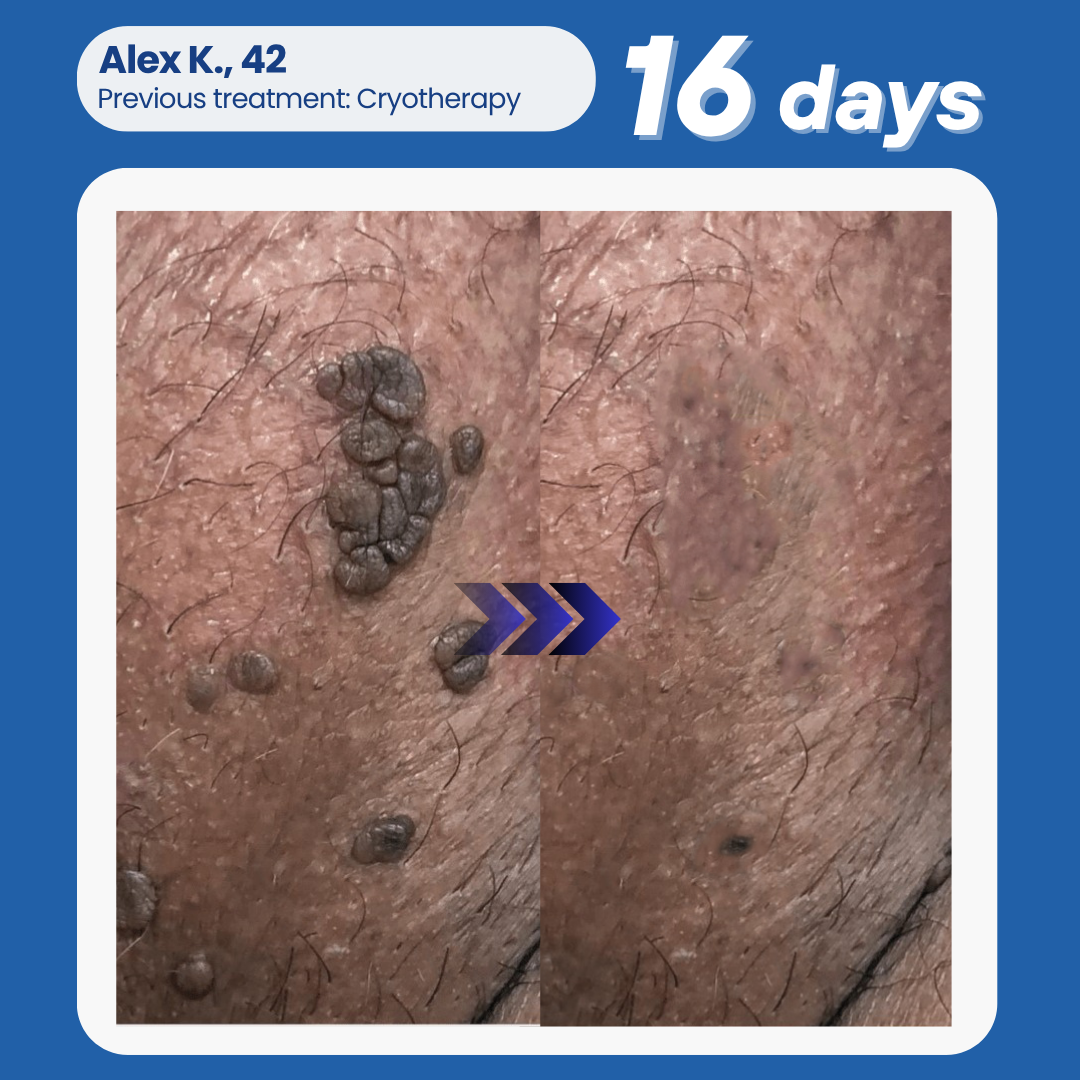 Oveallgo® NANOLIPO GENITAL WARTS CLINICAL AMPOULES 17 Oveallgo® NANOLIPO GENITAL WARTS CLINICAL AMPOULES