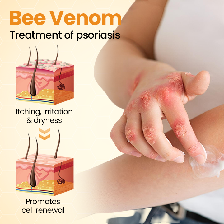 Oveallgo® BeeVenom Soothe Psoriasis Relief Cream