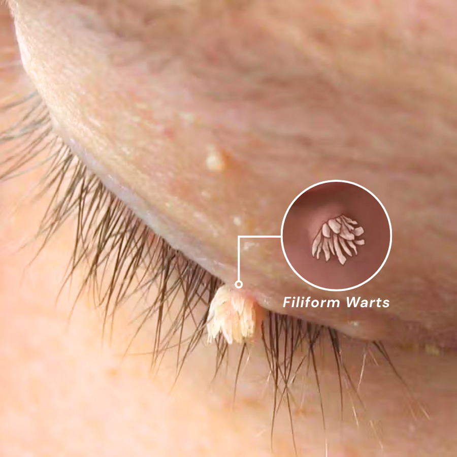 Lovilds® HPV Facial Filiform Warts Removal Cream