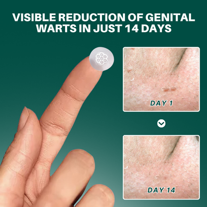 Fivfivgo® Magnesium MicroPin HPV Genital Wart Removal Patch Pro