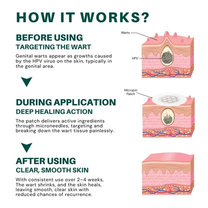 Fivfivgo® Magnesium MicroPin HPV Genital Wart Removal Patch Pro