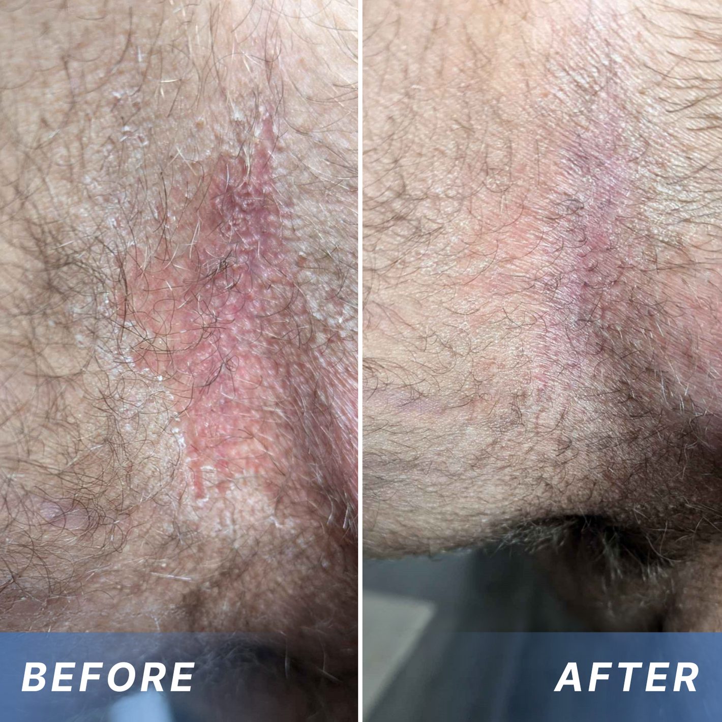 Fivfivgo® Advanced HPV & Rash Relief Genital Foam 24 Fivfivgo® Advanced HPV & Rash Relief Genital Foam