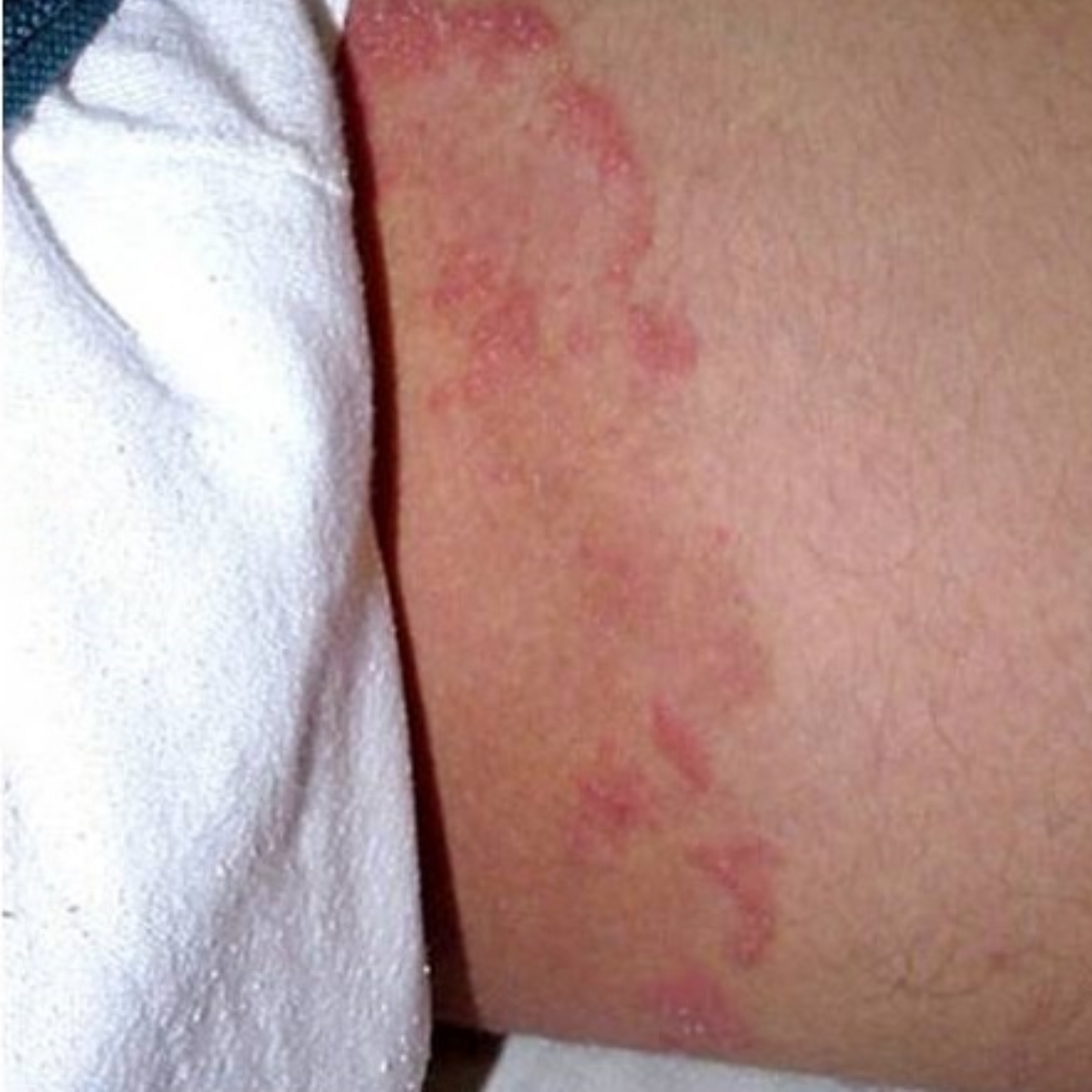 Fivfivgo® Advanced HPV & Rash Relief Genital Foam 31 Fivfivgo® Advanced HPV & Rash Relief Genital Foam