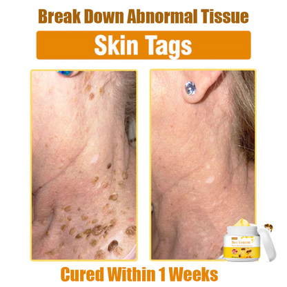✅Official Store Oveallgo™ Bee Venom Comprehensive Cream: Anti-aging, Hydrating, Skin Repair, Even Tone, Acne and Dark Spot Treatment, Wartand Mole Removal, PsoriasisRelief. (FDA Approved)