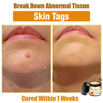 ✅Official Store: Oveallgo™ Bee Venom Skin Treatment Cream (𝐴𝐴𝐷 𝑅𝑒𝑐𝑜𝑚𝑚𝑒𝑛𝑑𝑒𝑑) ✨Anti-aging, Hydrating, Skin Repair, Even Tone, Acne and Dark Spot Treatment, Wartand Mole Removal, PsoriasisRelief