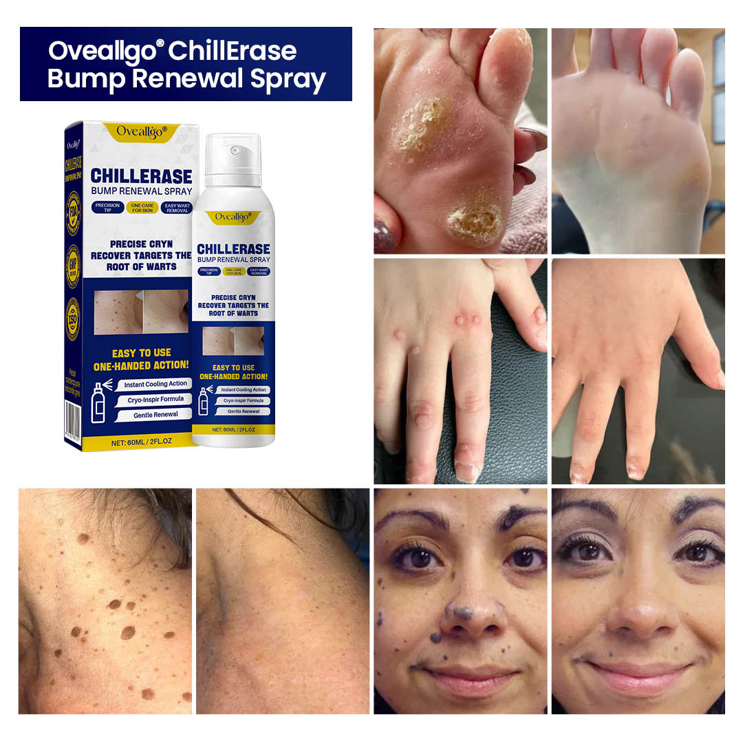 Oveallgo® ChillErase Bump Renewal Spray