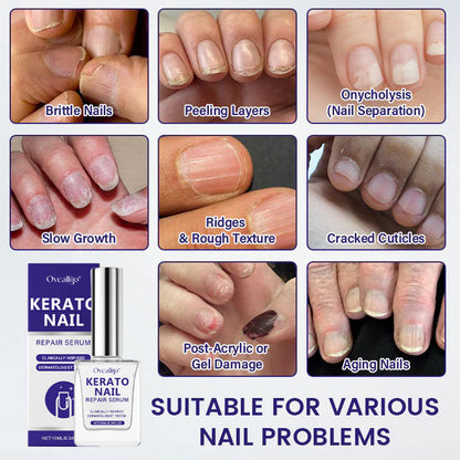 Oveallgo®  KeratoNail Repair Serum ( Rebuild Stronger, Healthier Nails from the Root - Clinically inspired serum that restores brittle, peeling, and splitting nails with cutting-edge keratin-repair technology )