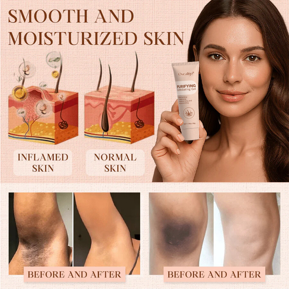 Oveallgo® Purifying Exfoliating Gel for Acanthosis Nigricans, Exfoliation, Dark Spots, Skin Tags, and Eczema_Ultra01