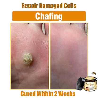 ✅Official Store: Oveallgo™ Bee Venom Skin Treatment Cream (𝐴𝐴𝐷 𝑅𝑒𝑐𝑜𝑚𝑚𝑒𝑛𝑑𝑒𝑑) ✨Anti-aging, Hydrating, Skin Repair, Even Tone, Acne and Dark Spot Treatment, Wartand Mole Removal, PsoriasisRelief
