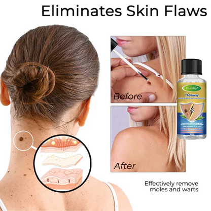 Oveallgo® TAGAway Moles & Warts Removal Solution